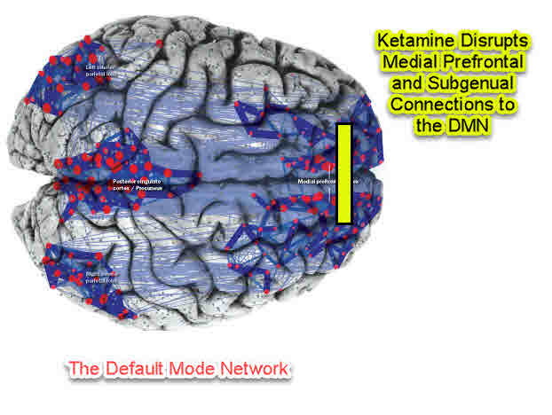 Default Mode Network And Depression Treatment - Ketamine And TMS ...